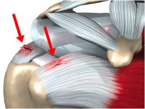 Musculoskeletal image of a tendinosis injury to the knee