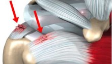 Musculoskeletal image of a tendinosis injury to the knee