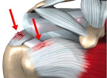 Musculoskeletal image of a tendinosis injury to the knee